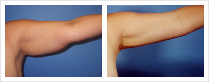 二の腕の症例写真1