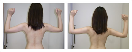 二の腕・背中の症例写真3-1