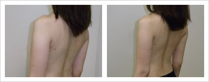 二の腕・背中の症例写真3-2