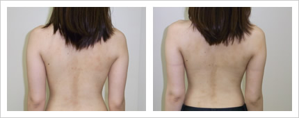 二の腕・背中の症例写真3-3