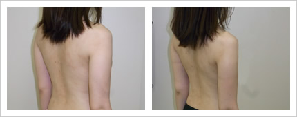 二の腕・背中の症例写真3-4
