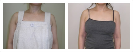 二の腕・肩の症例写真4-1