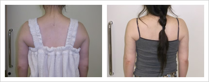 二の腕・肩の症例写真4-2