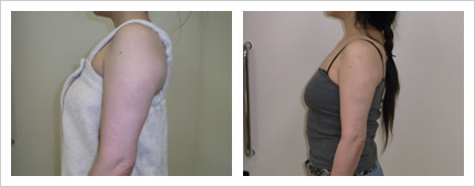 二の腕・肩の症例写真4-3