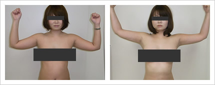 二の腕・背中の症例写真5-1