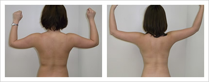 二の腕・背中の症例写真5-2