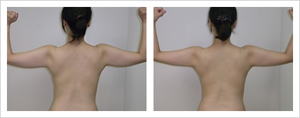 二の腕・背中の症例写真6-2